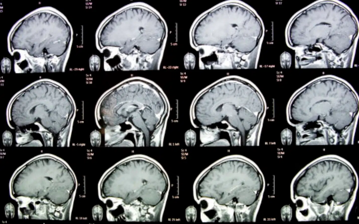 Cirka 500 mænd og kvinder dør årligt i Danmark på grund af en hjernetumor, viser tal fra Kræftens Bekæmpelse. Her ses en MR-scanning af lidt ældre dato.