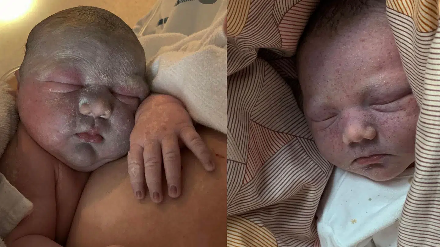 Sådan så Signe ud, da hun kom til verden. Med grå hud og små røde prikker.