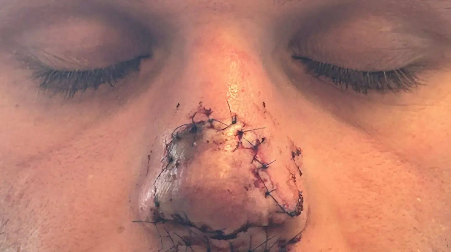 Lægerne kunne ikke sige med sikkerhed, hvor mange sting, Christian fik i næsen, men det var over 25.