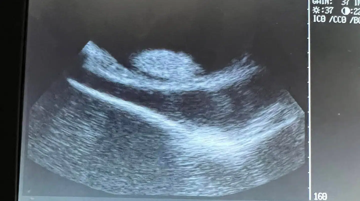 Her ses et scanningsbillede af graviditeten.