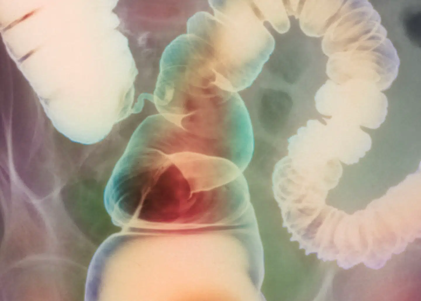 Røntgenbillede af en irriteret tyktarm.