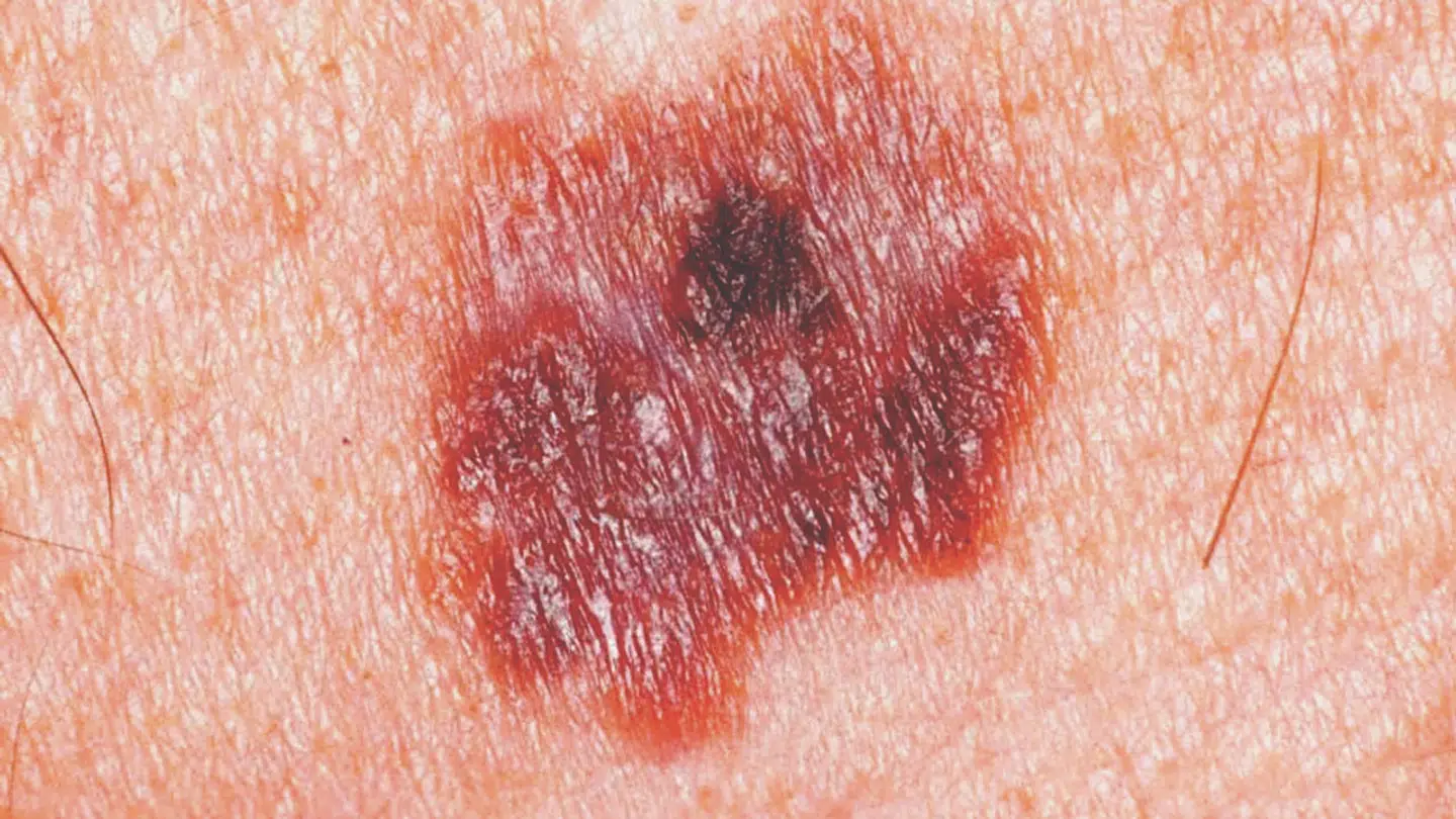 Nyt forsøg lover godt for fremtidens behandling af modermærkekræft.