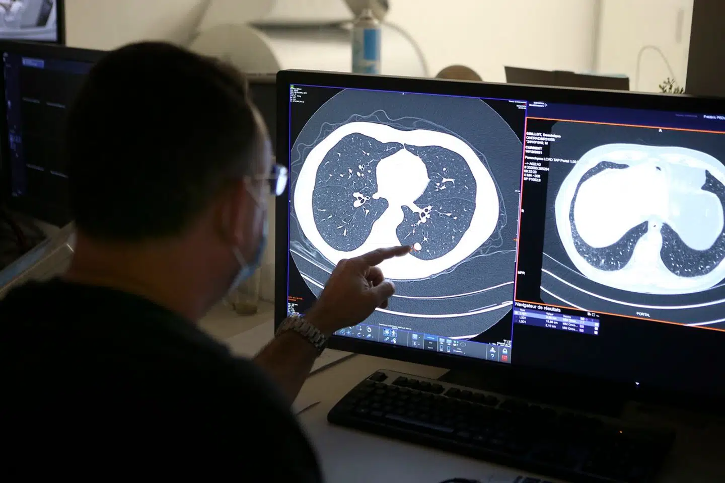 Lungekræft rammer hvert år omtrent 5.000 danskere.