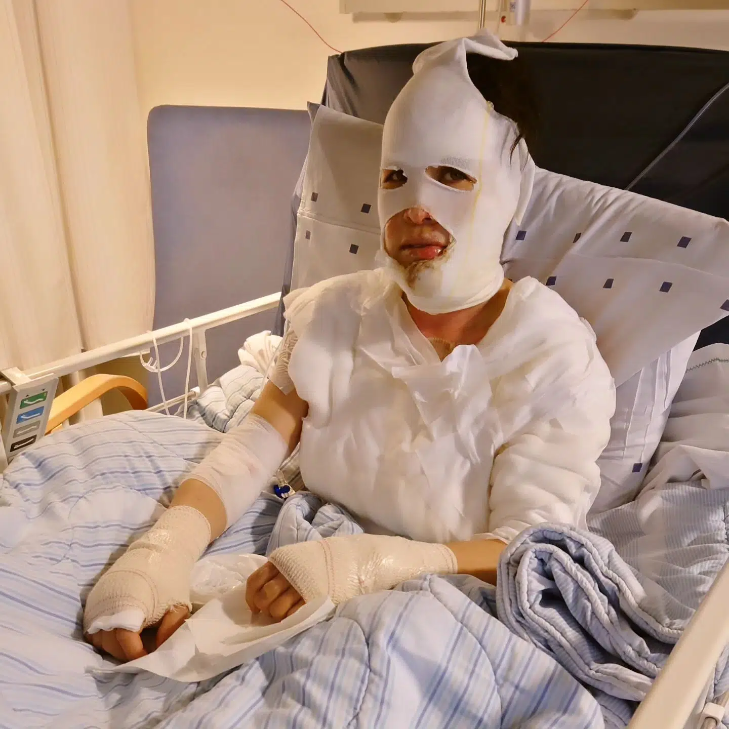 Her ses Annemette Pauline Bendt, da hun vågnede fra den kunstige koma, hun blev lagt i efter at være blevet forbrændt i begyndelsen af marts. Det skete, da hun skulle fylde ethanol på sin biopejs.