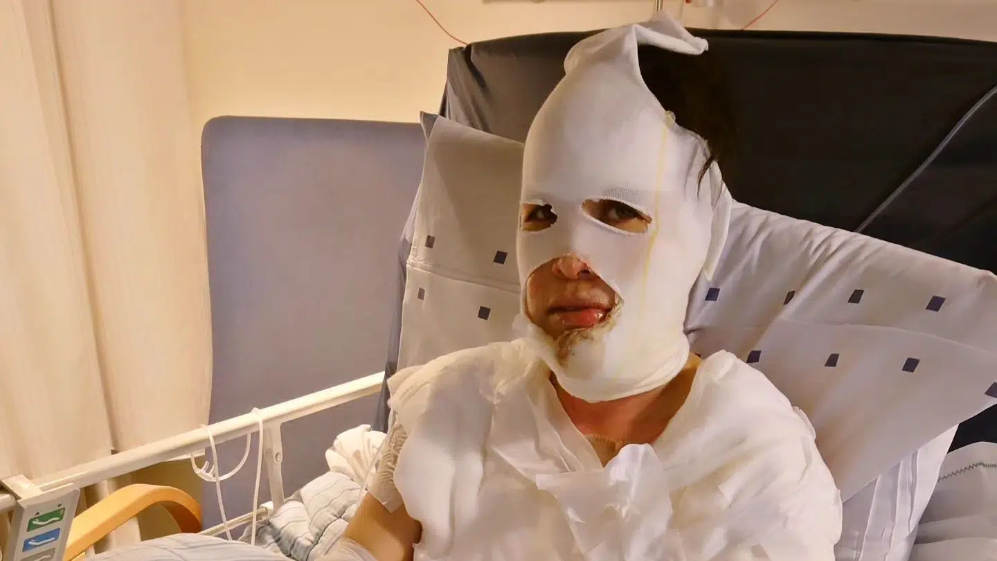 Her ses Annemette Pauline Bendt, da hun vågnede fra den kunstige koma, hun blev lagt i efter at være blevet forbrændt i begyndelsen af marts. Det skete, da hun skulle fylde ethanol på sin biopejs.