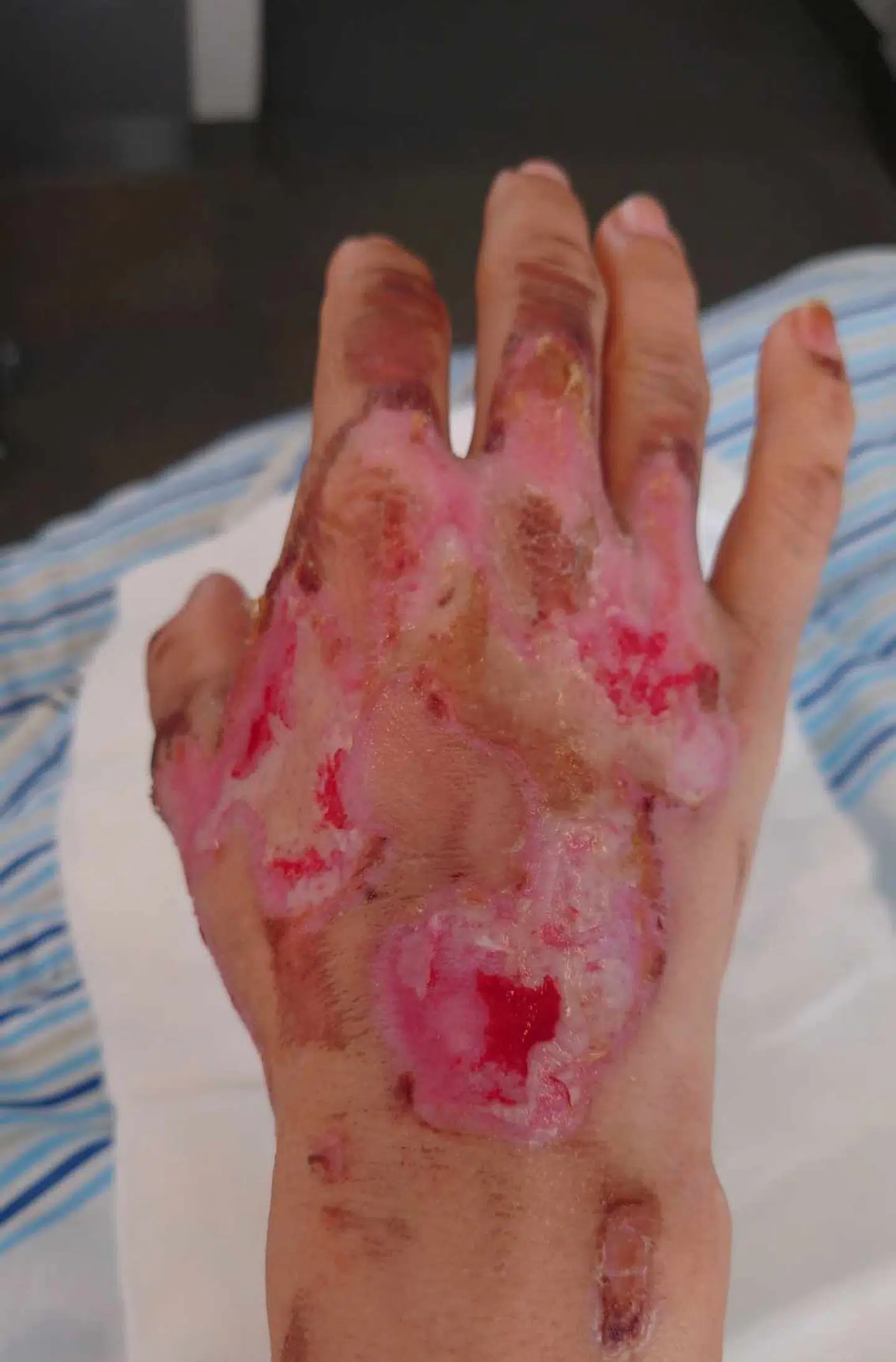 Sådan så Annemettes hånd ud 14 dage efter ulykken.