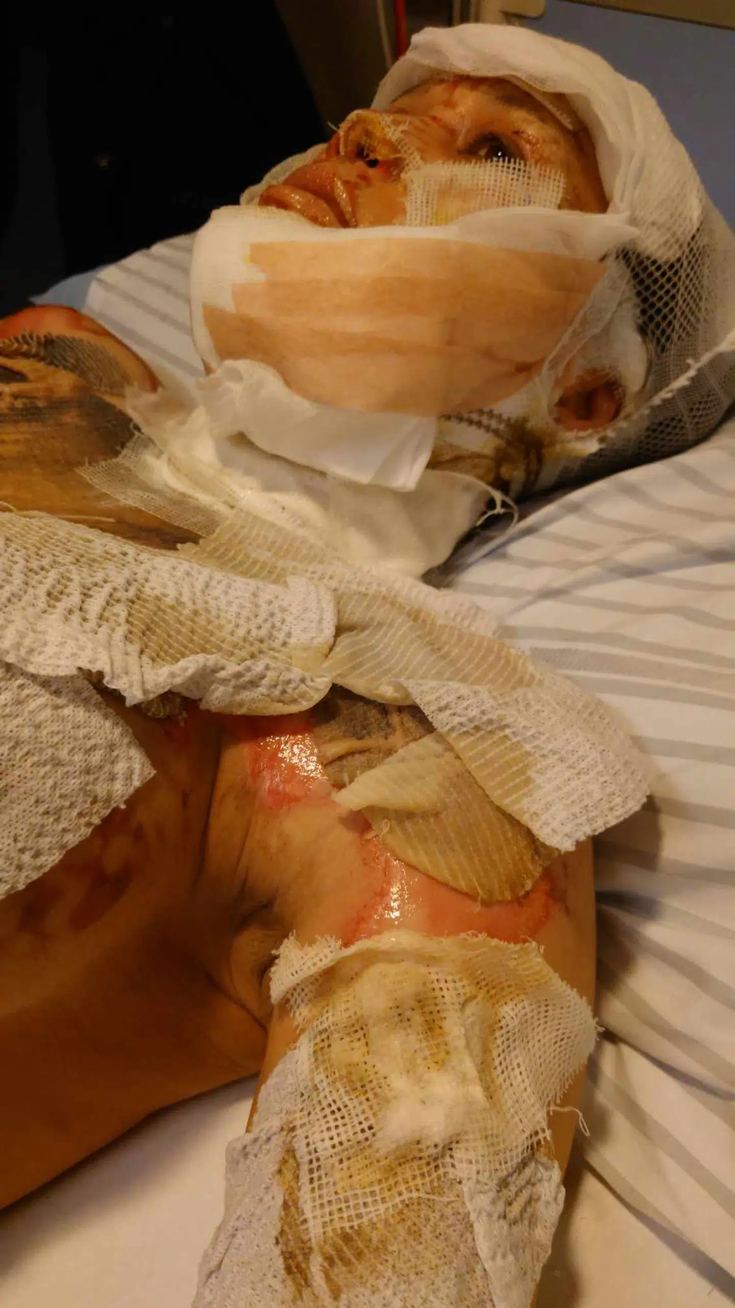 Noget af det mest smertefulde har været, når der skulle skiftes bandager på de mange sår. Her er et billede fra en af gangene.