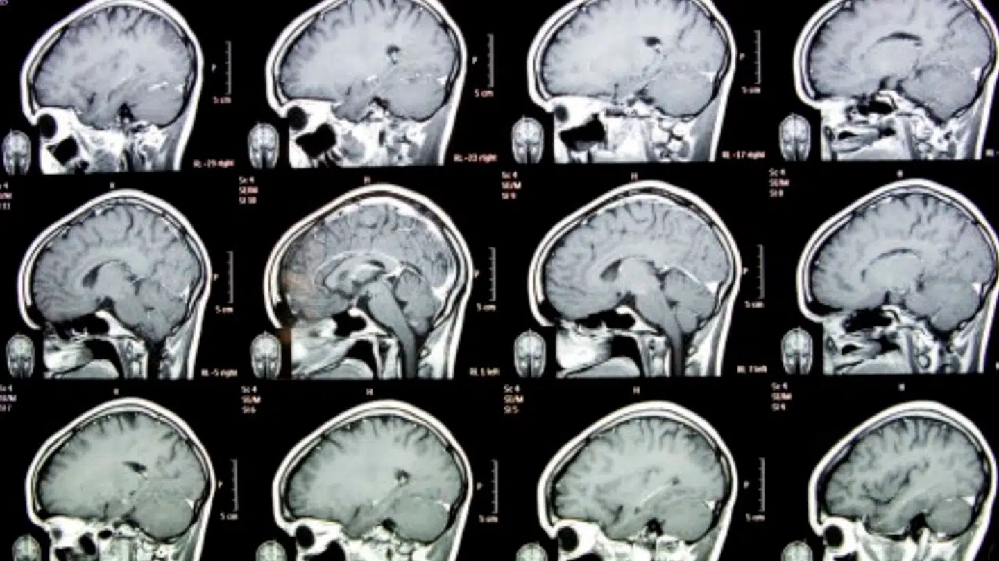 Franske forskere tror, at Ozempic lignende middel kan virke mod endnu en sygdom.