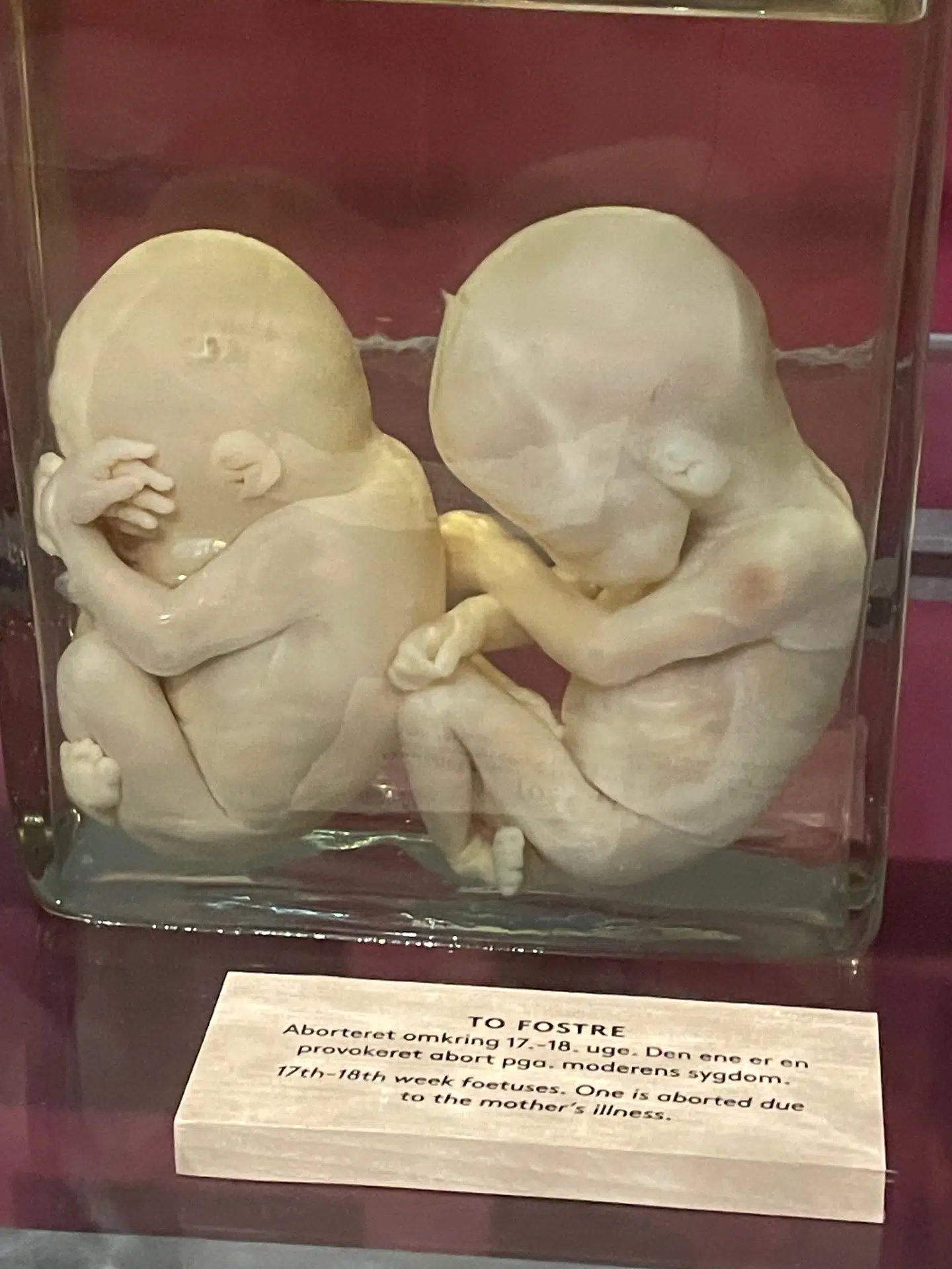 Konserverede fostre. Udstillet på Medicinsk Museion som en del af en større udstilling, der ikke handler om abortgrænsen.