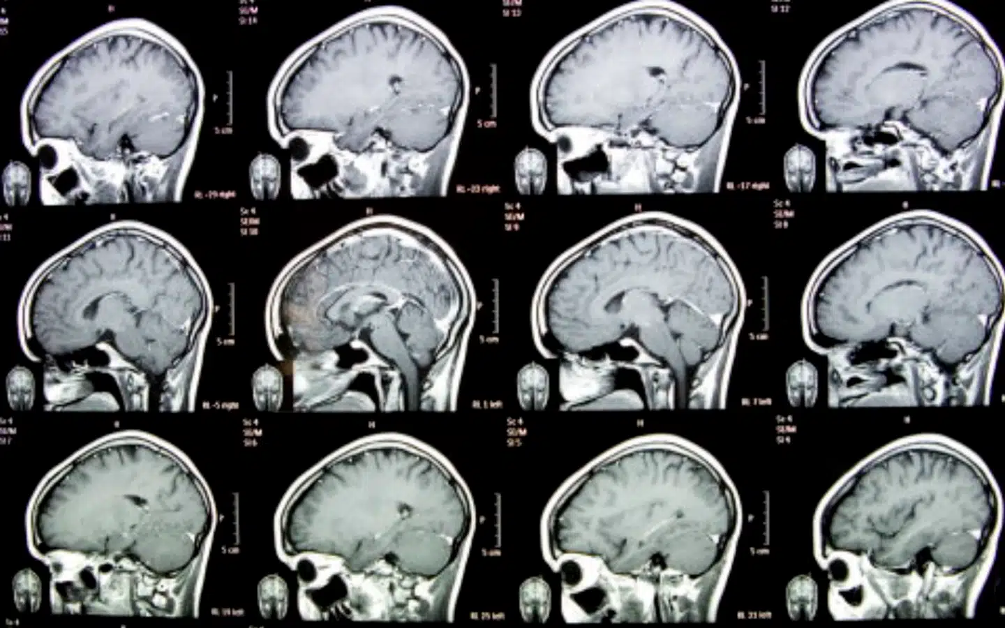 Glioblastom er den hyppigste hjernetumor med omkring 300 tilfælde årligt i Danmark ifølge Kræftens Bekæmpelse. Billedet er fra en MR-scanning af en rask hjerne.