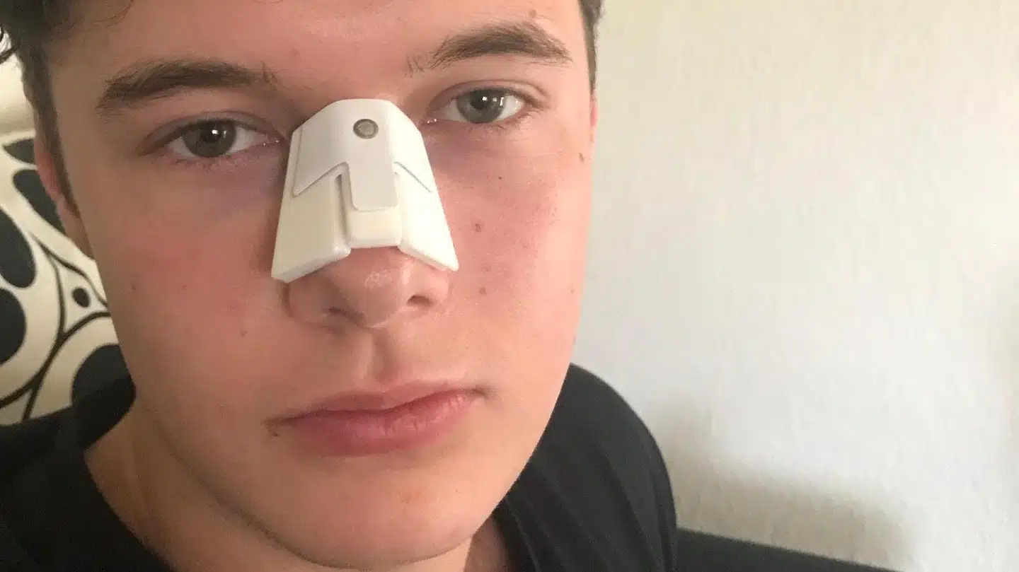 Silas efter overfaldet. Privatfoto.