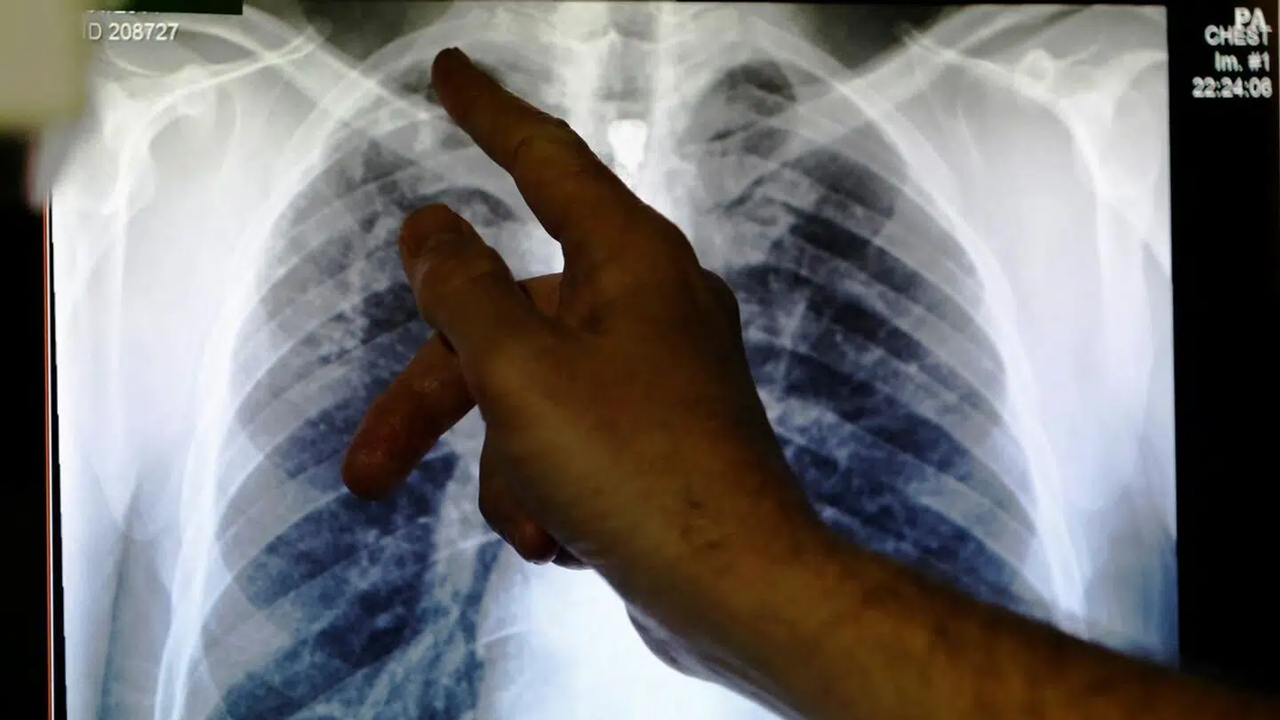 Lægerne har set et stop i udviklingen af lungekræft på patienter. ARKIVFOTO.