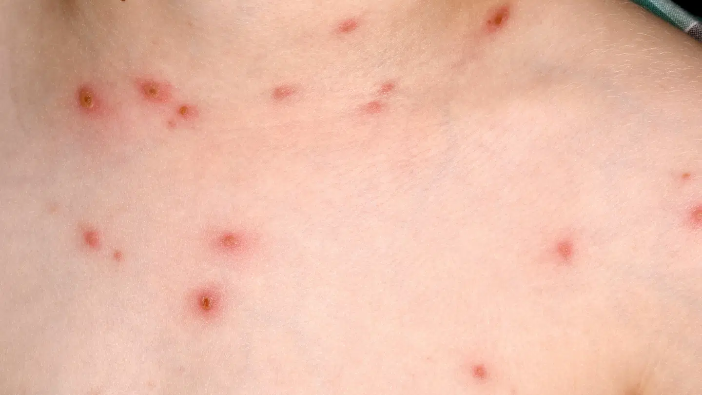 En særlig sygdom kan tvinge familien til at forlænge sommerferien, skriver Dagbladet.