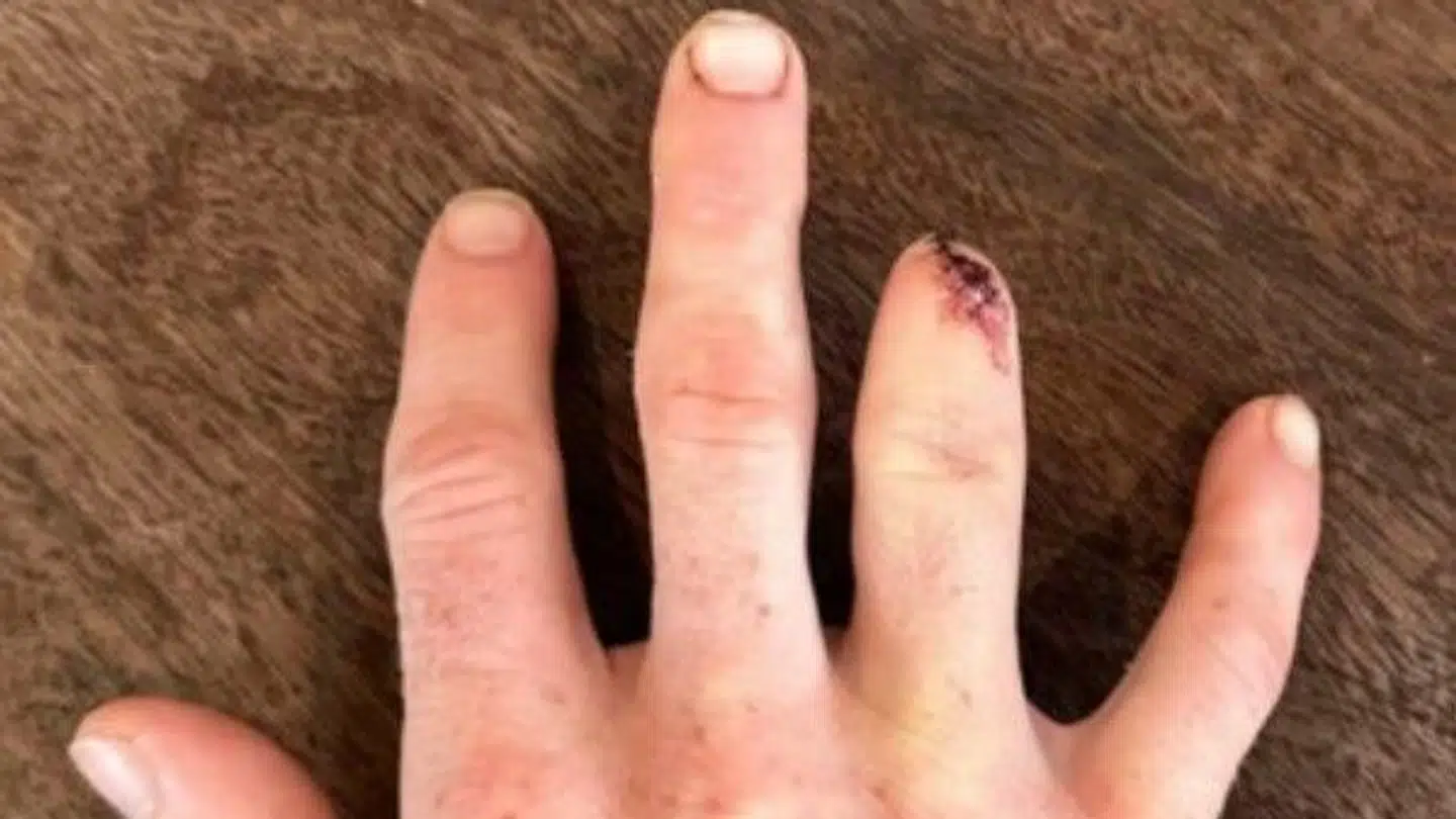 Matthew Dawsons finger efter amputationen.