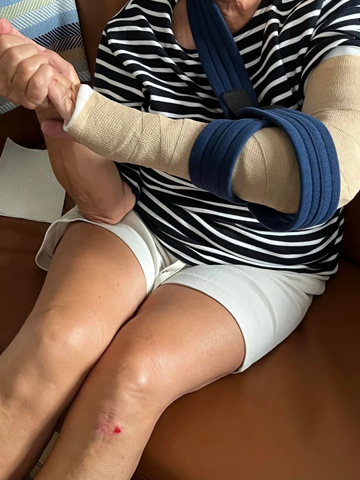 Armen er nu i gips, og Pia Kjærsgaard venter nu på at få tid til en operation.