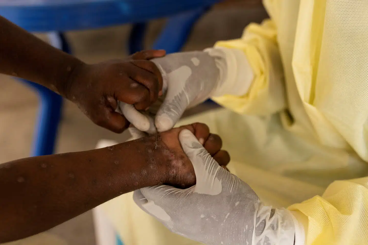 Der har siden begyndelsen af 2024 været et udbrud af mpox i Den Demokratiske Republik Congo (DR Congo), som siden har spredt sig til nabolande (Arkivfoto).