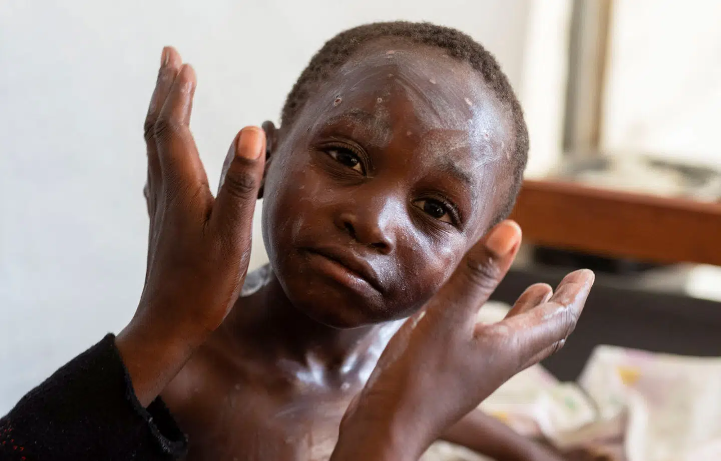 Den variant af mpox-virus, der for tiden spreder sig i Afrika, ser især ud til at ramme børn under 15 år.