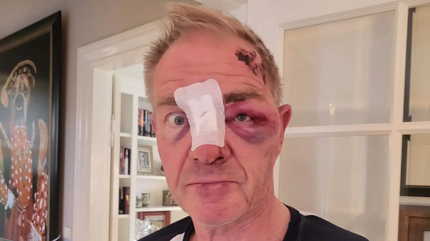 Sådan så Christian Mengel ud efter mødet med den aggressive ko