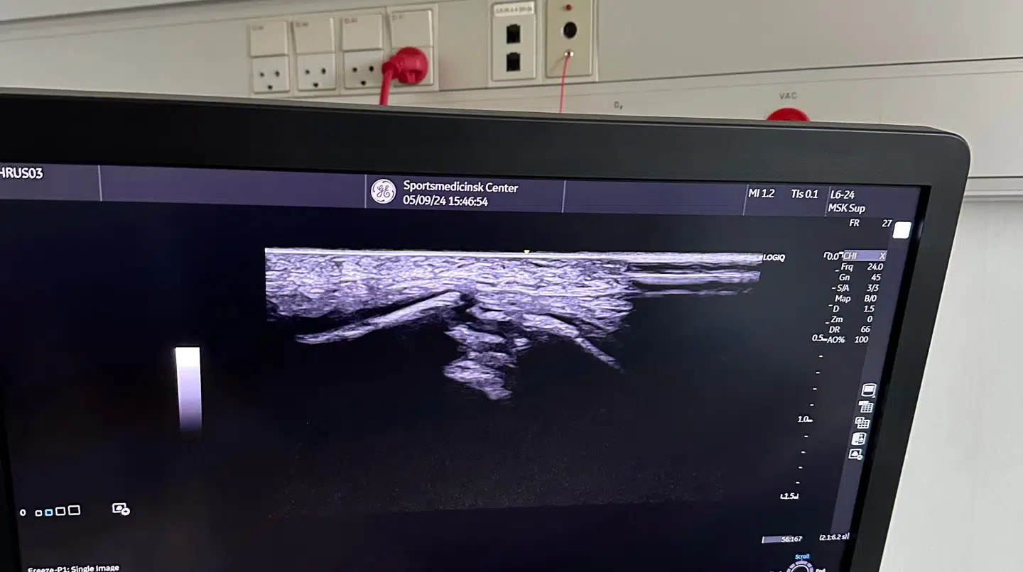 Hoppet i svømmehallen kostede et brækket haleben.