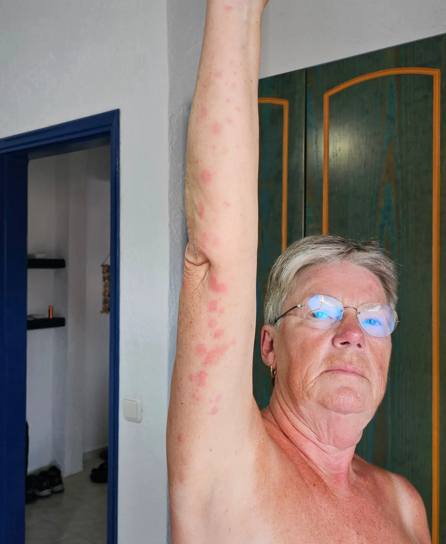 Lis Becher er blevet bidt i hovedet, nakken og på sine arme, hænder og ben.