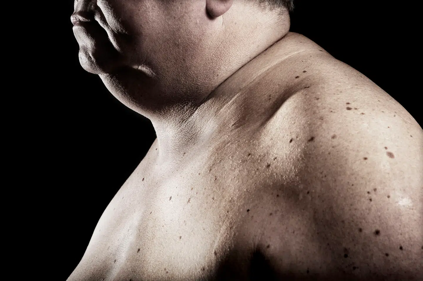 »Den bedste medicin mod fedme er ikke sprøjter og piller, men salat og en løbetur,« skriver Jonas Schmidt.