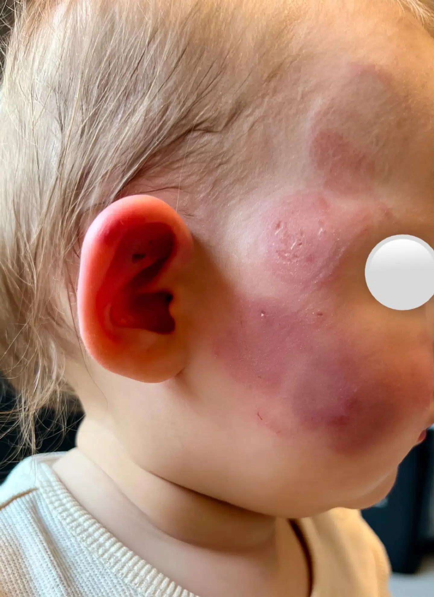 Her ses lille Ella med de mange bid i ansigtet. Hun kom hjem med i alt ti bid fra et andet barn.