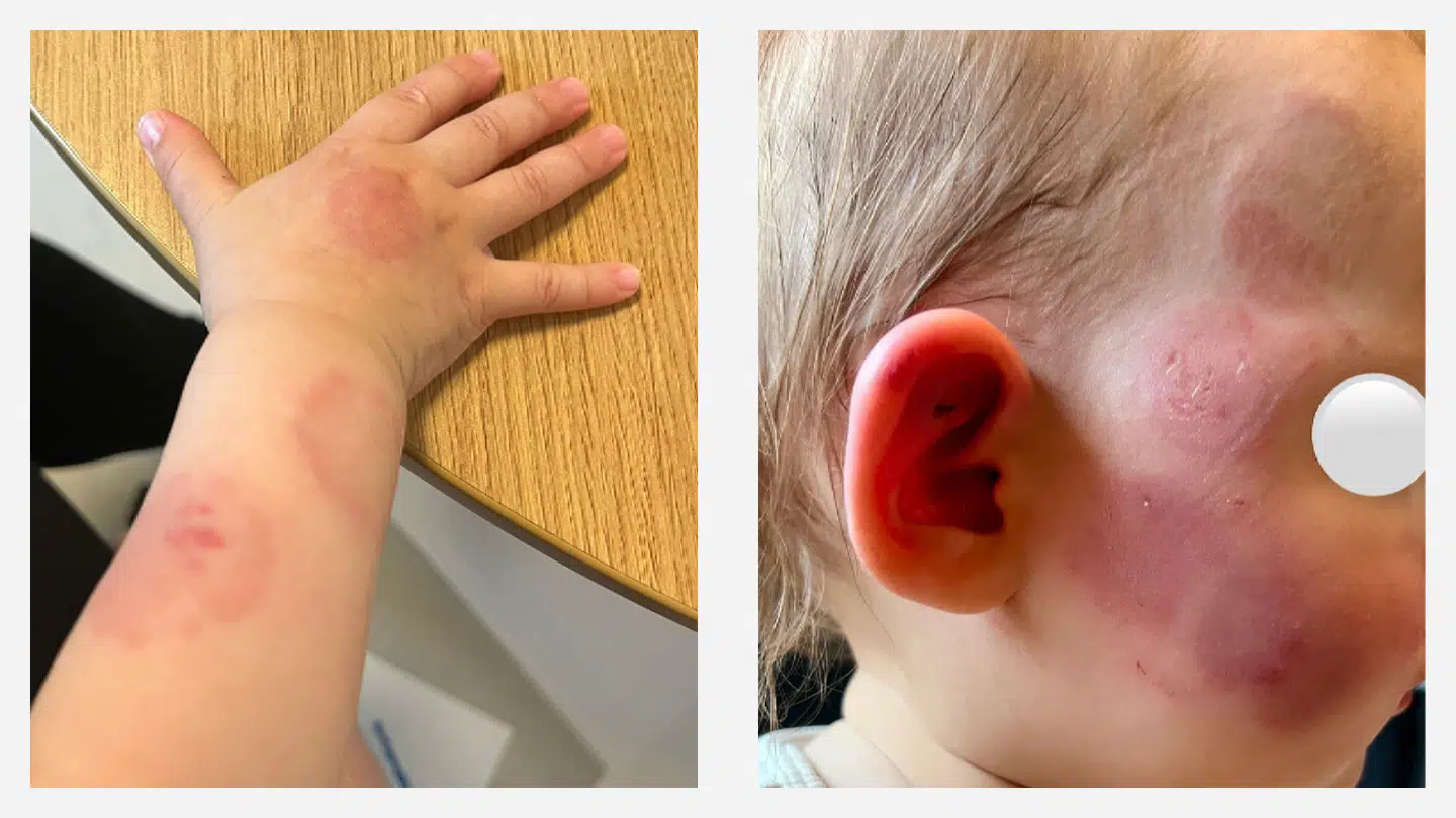 Her ses flere af de bidemærker, som halvandet år gamle Ella fik efter at være blevet efterladt i et rum med et andet barn.