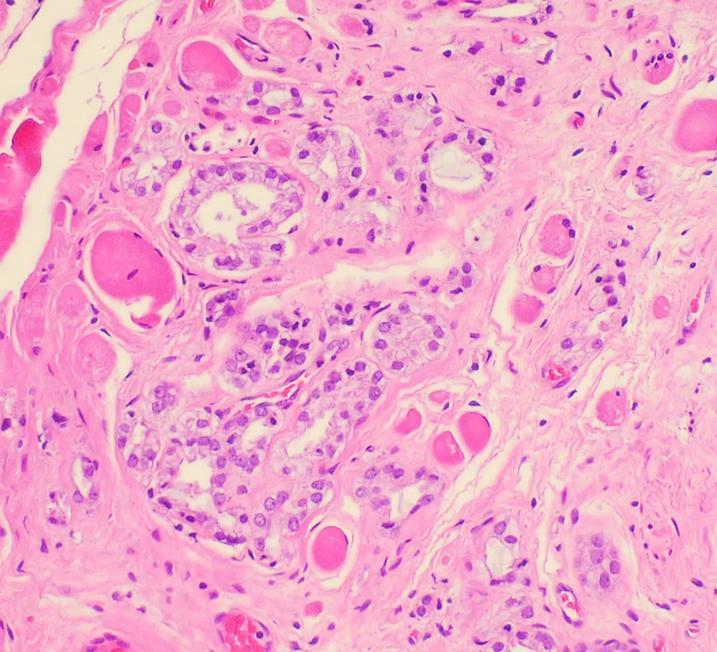 Histopatologi af prostata adenokarcinom. Arkivfoto: Mikael Häggström, Wikimedia Commons