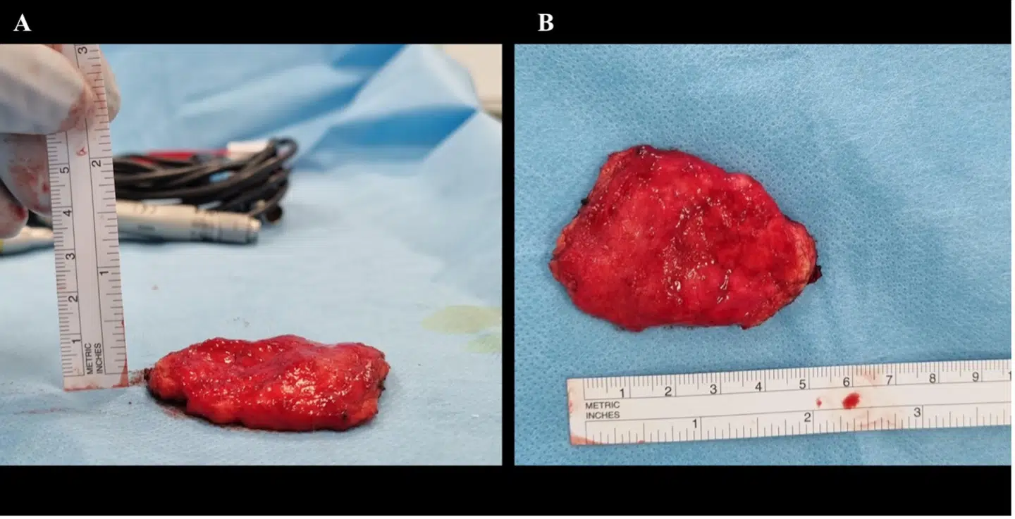 Et billede af den godartede svulst, som lægerne har fjernet fra en breakdancers hoved.