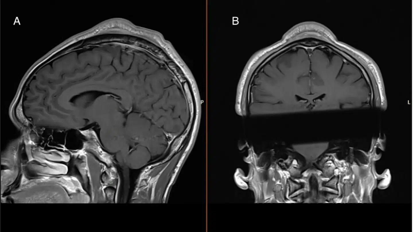 På scanninger kunne lægerne tydeligt se bulen.