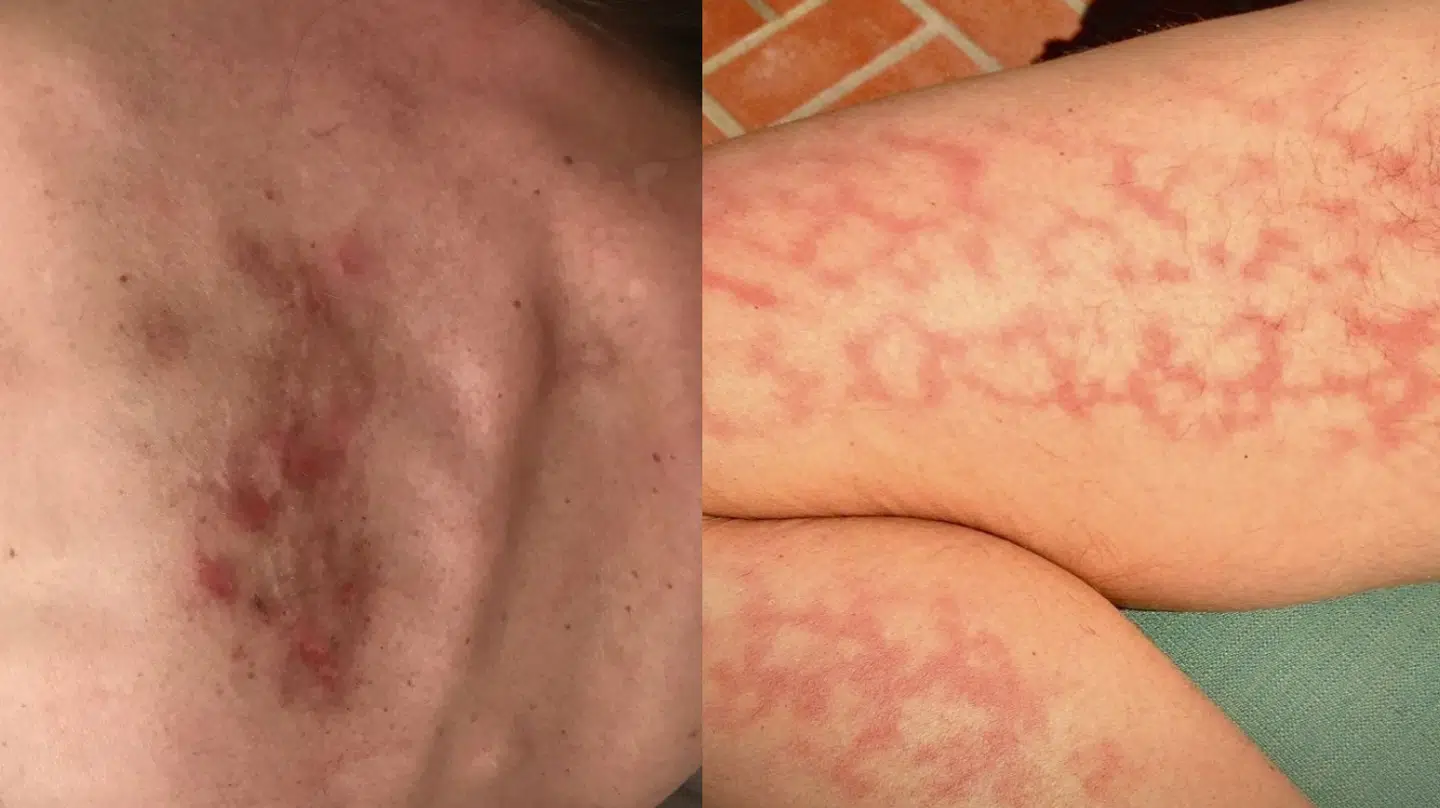 Lisa Klits sygdomme viser sig blandt andet med smertefulde udslæt og infektioner i kroppen.