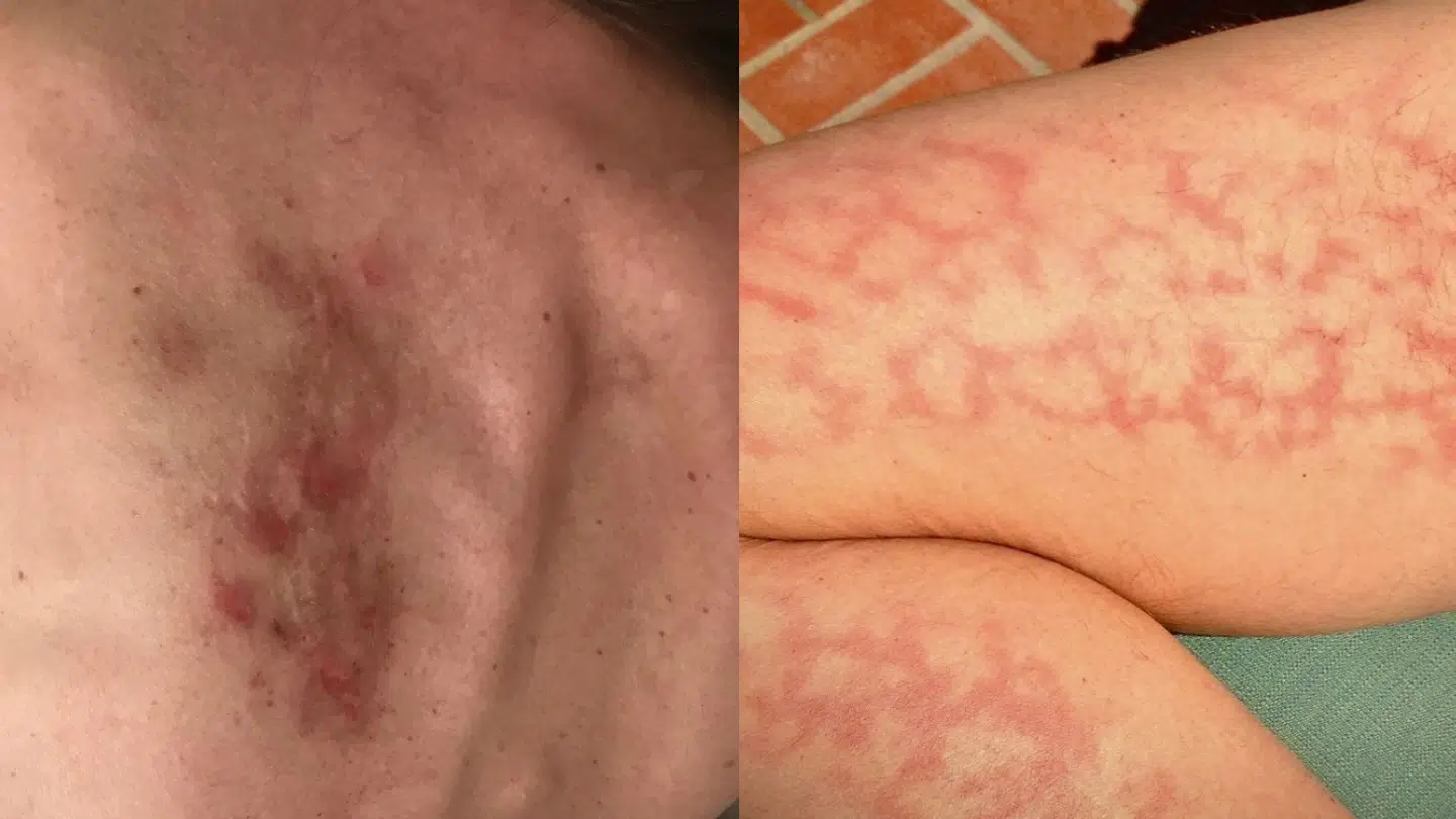 Uden behandling får Lisa Klit periodevise smertefulde udslæt og infektioner i kroppen.