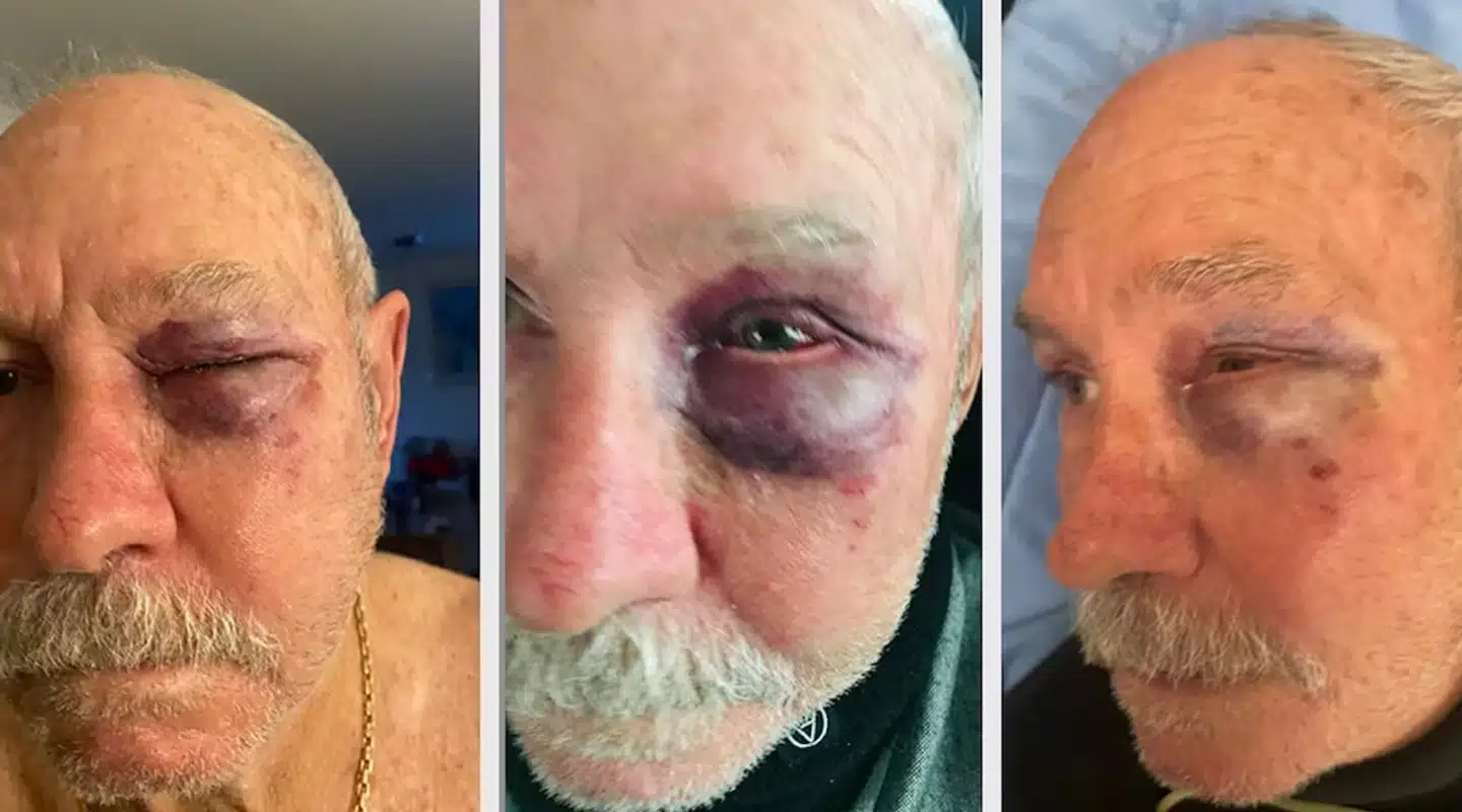 Poul Andersen med sit blå øje. Han er 77 år og frivillig fodbolddommer. Foreningsidræt har svært ved at tiltrække og fastholde fodbolddommere. Stigning i trusler gør det endnu sværere, siger formand for Danske Fodbolddommeres Union, Jens Rohde. Prvatfoto