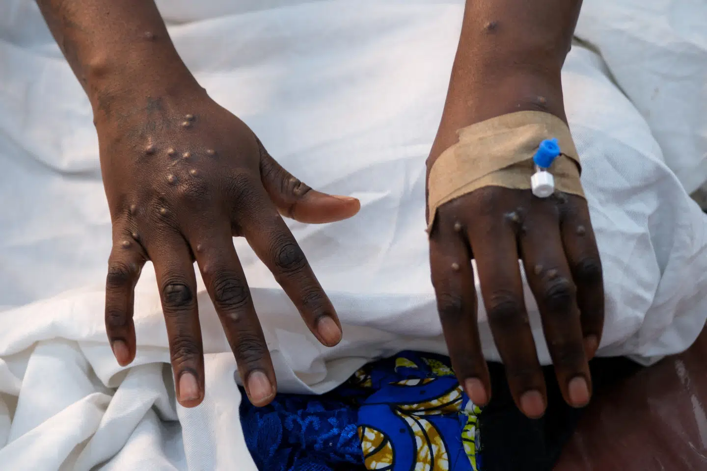 Her ses hænderne fra en person smittet med mpox.
