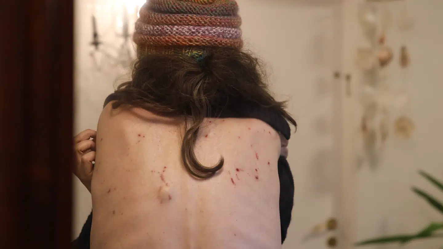 Lisas sygdomme gør blandt andet, at hun får smertefulde udslæt på kroppen. Når hun ikke får medicin, falder hun ofte ud og ind af bevidsthed eller er i kramper.