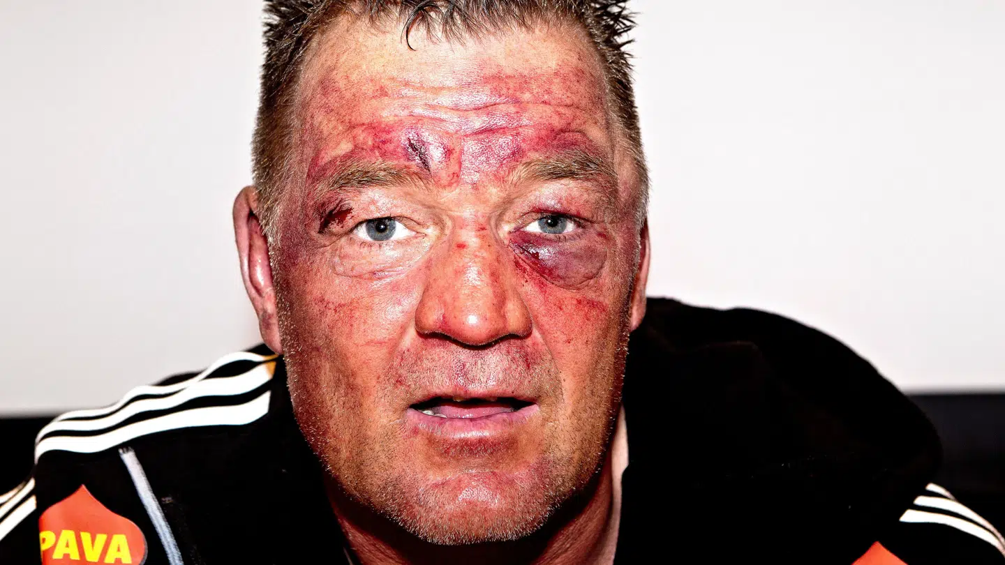 Boksekæmpen Brian Nielsen har holdt sig opretstående i utallige boksekampe, men de sidste år har operationer lagt ham ned.