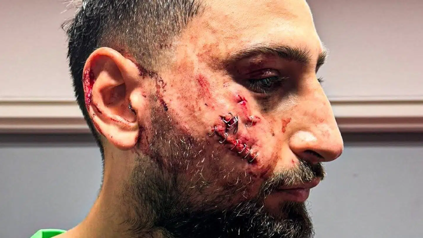 Donnarumma var hårdt medtaget og clipset sammen i ansigtet.