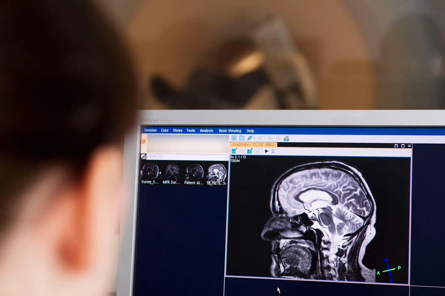 Børn bliver kan også blive ramt af en hjerneblødning eller blodprop i hjernen. Nu er der udsigt til en bedre behandling.