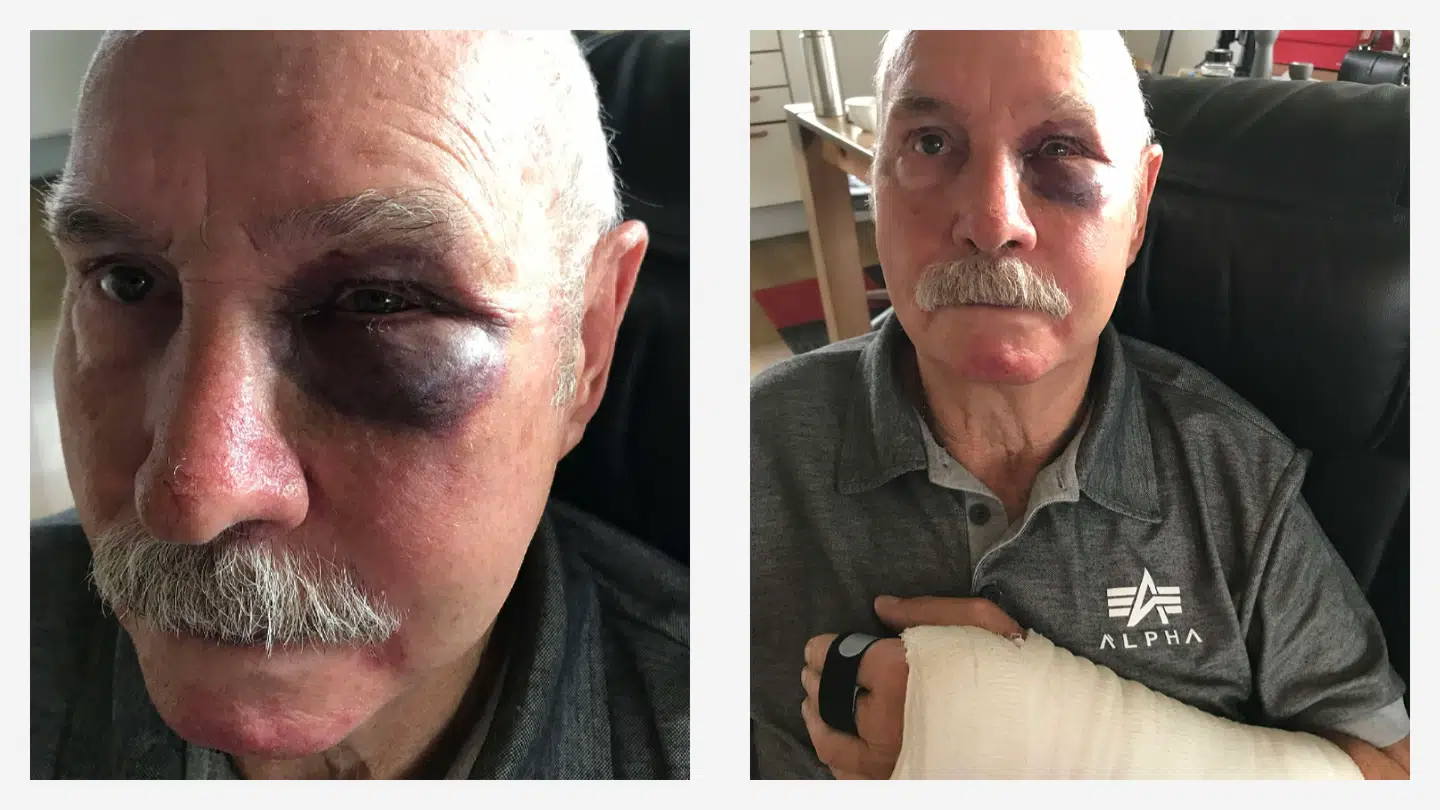 Poul Andersen fik en skalle af en forælder til en fodboldkamp i oktober. Han er stadig i mange smerter efter overfaldet.