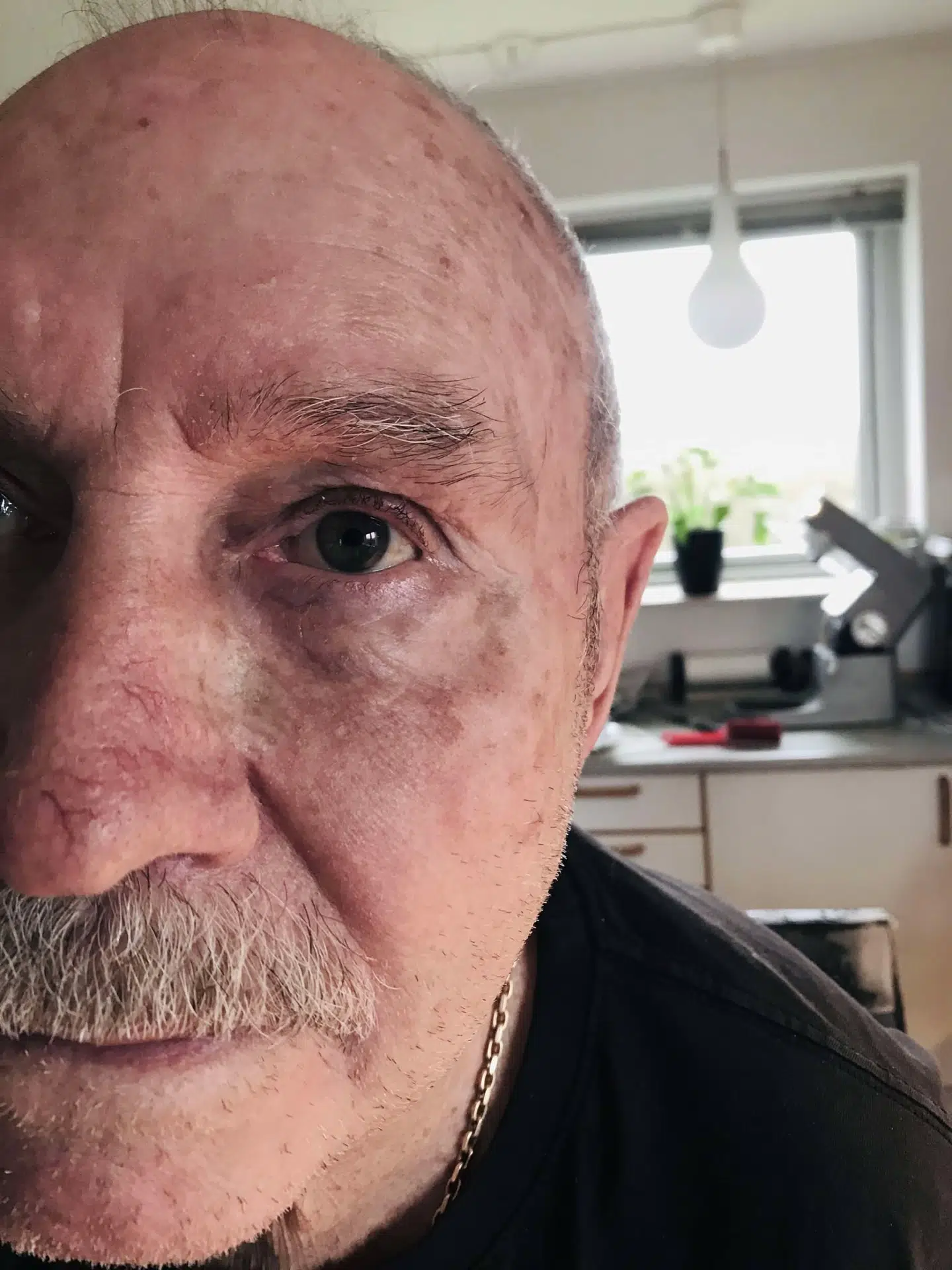 Sådan ser Poul Andersen ud i dag. Han er stadig i store smerter.