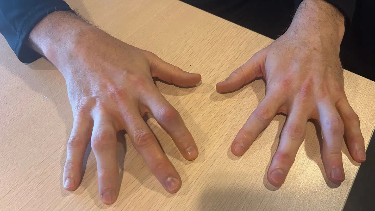 Efter et langt håndboldliv har kroppen fået en del skavanker. Her er der Møllgaards fingre.
