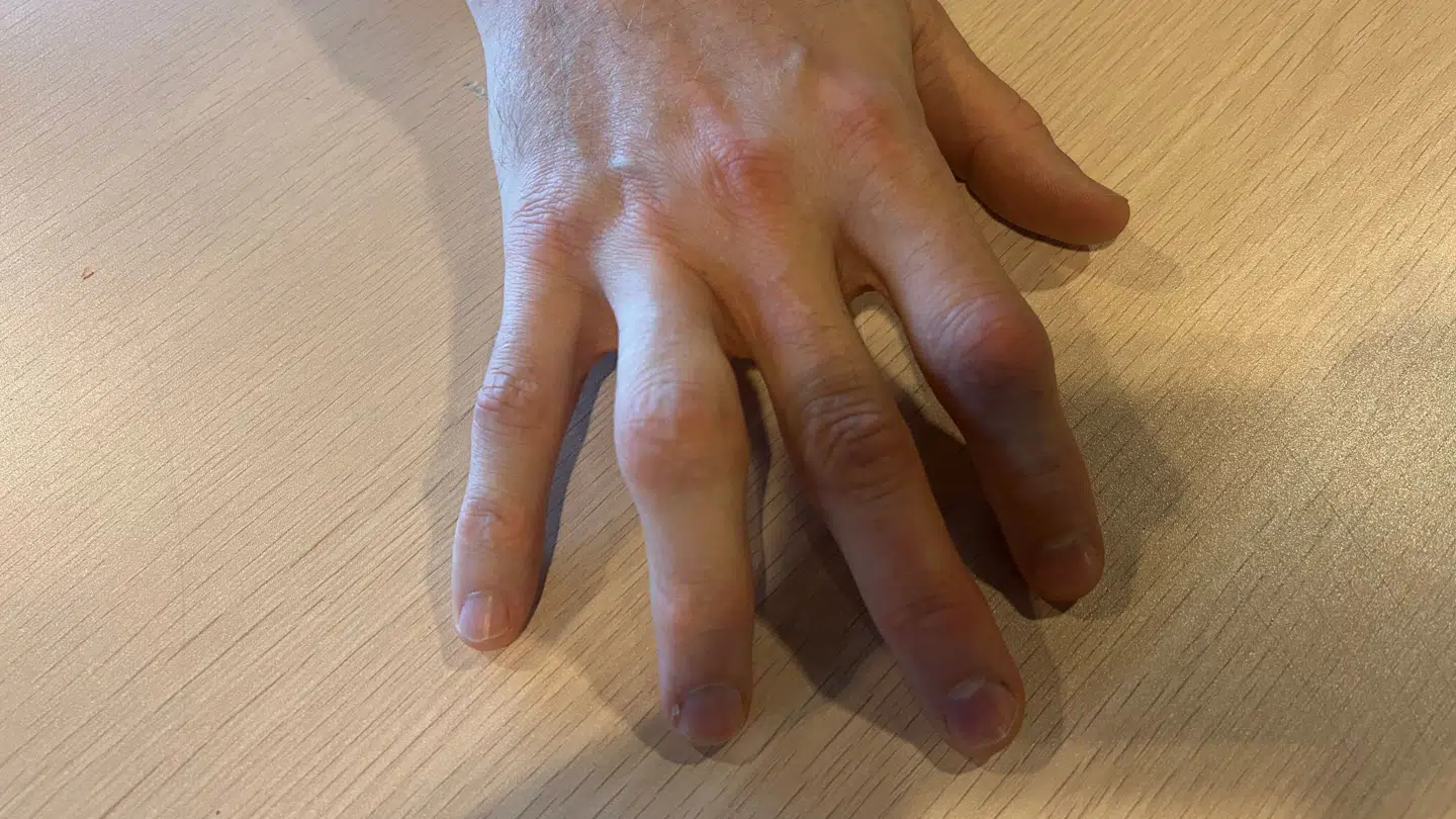Sådan ser en håndboldhånd ud efter over 20 år på banen.