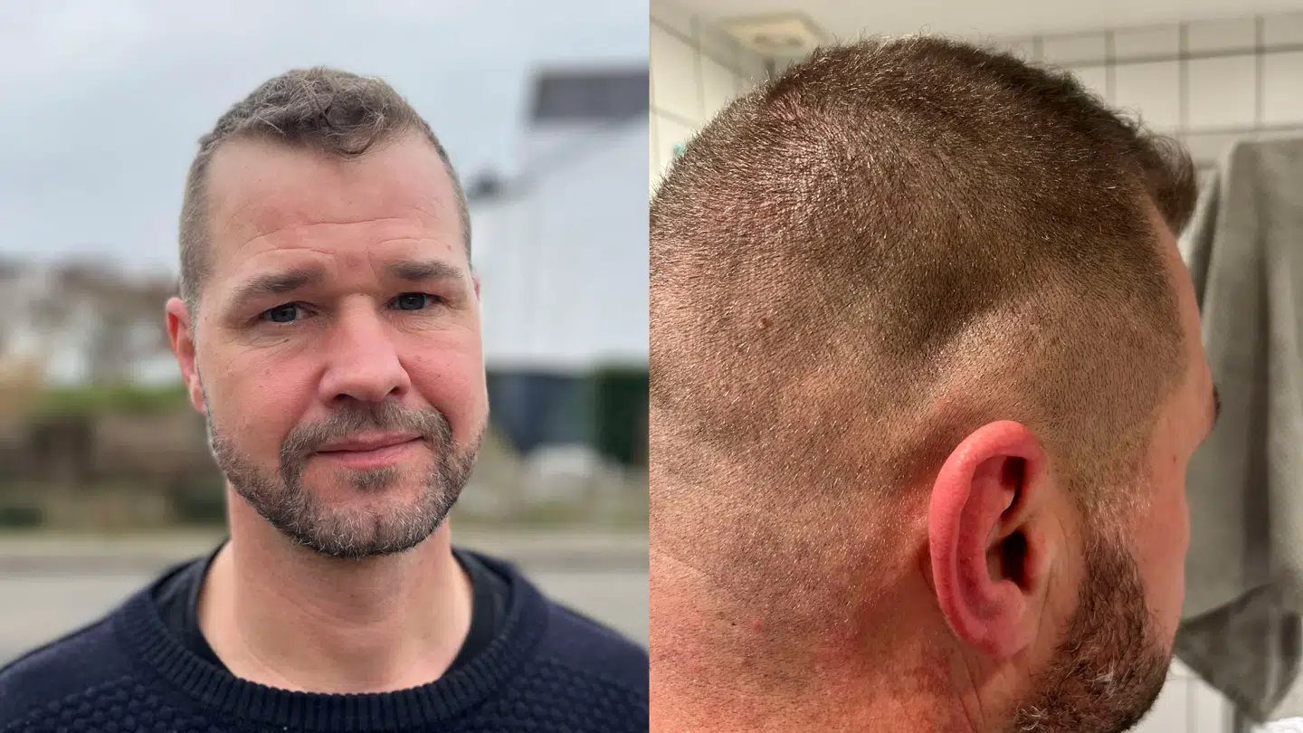 Til venstre ser du Mads From. Til højre ser du den indvendige bule, han har fået efter slaget med gummihammeren.
