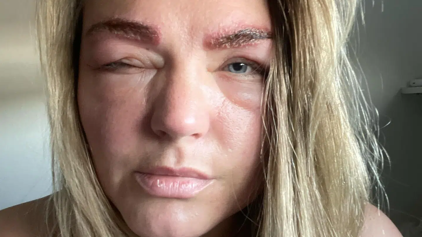 Louise Pihl traf for 23 år siden en beslutning, som har fulgt hende lige siden. I dag er hendes ansigt hævet til uigenkendelighed.