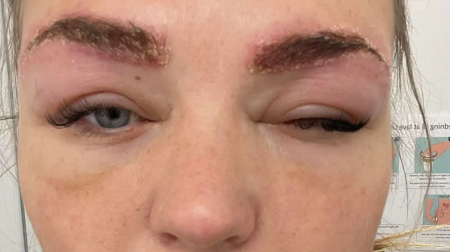 Sådan så Louise Pihl ud i mandags, efter hun fik farvet øjenbryn fredag i sidste uge. Hendes PPD-allergi reagerede på indholdet af det syntetiske farvestof i øjenbrynsfarven.