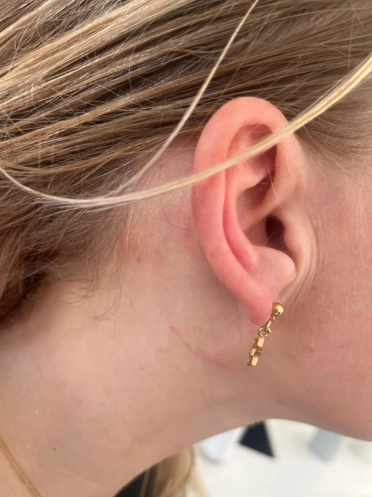 Mærker på kvindens hals efter overfaldsmanden på Christiania tog kvælertag.