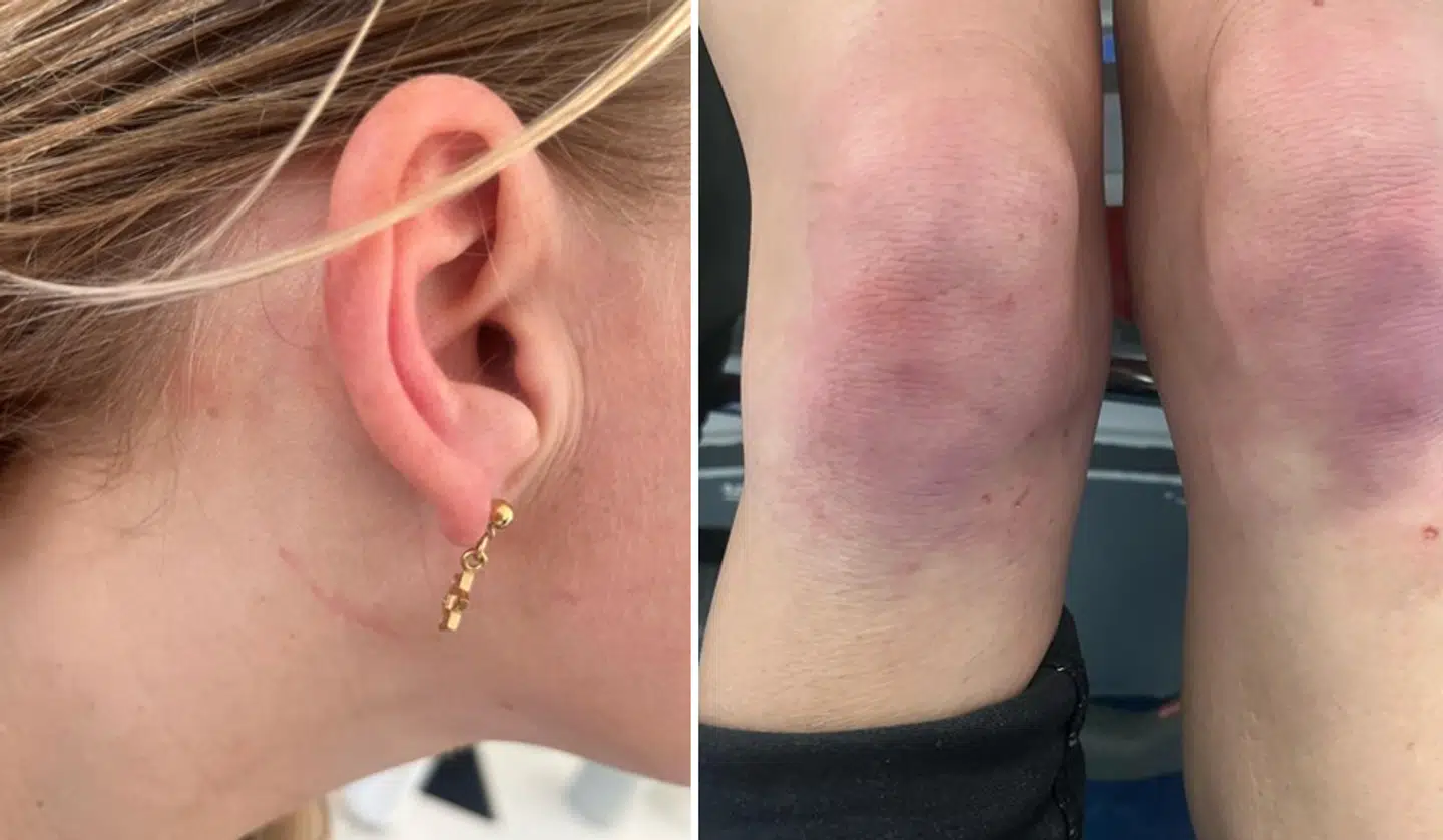 Skrammerne efter overfaldet på Christiania.