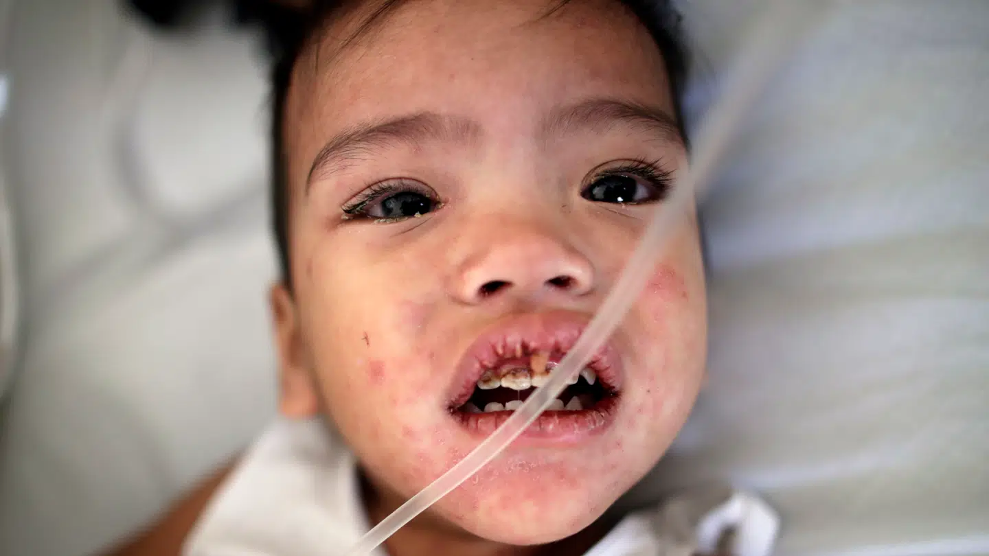 Arkivfoto. Mæslingesmitten spreder sig hastigt i Europa. Her et billede fra et udbrud i Filippinerne.