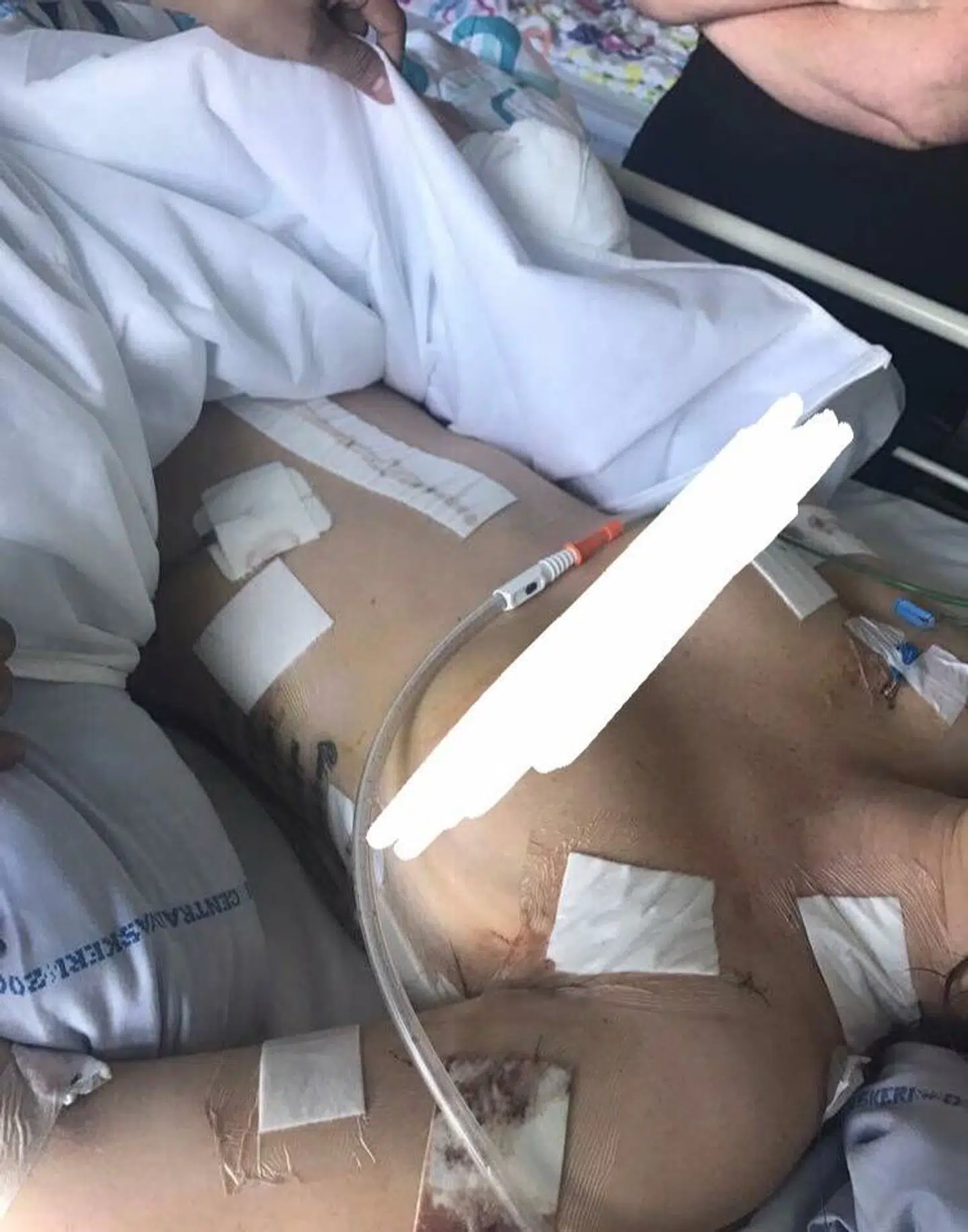 Cecilie Danris blev stukket 46 gange af sin ekskæreste i maj 2017. Her ses hun få dage efter overfaldet.