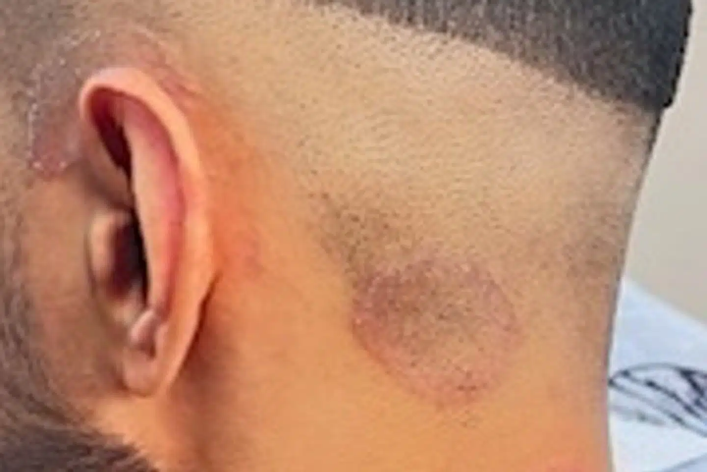 Symptomerne på Tinea capitis er rødme, skæl og knækkede hårstrå på et mindre og velafgrænset område. Infektionen kan også give bylder.